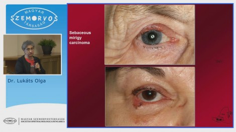 Szemkörnyéki daganatok és sebészi kezelésük