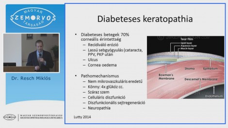 A szaruhártya elváltozásai cukorbetegségben